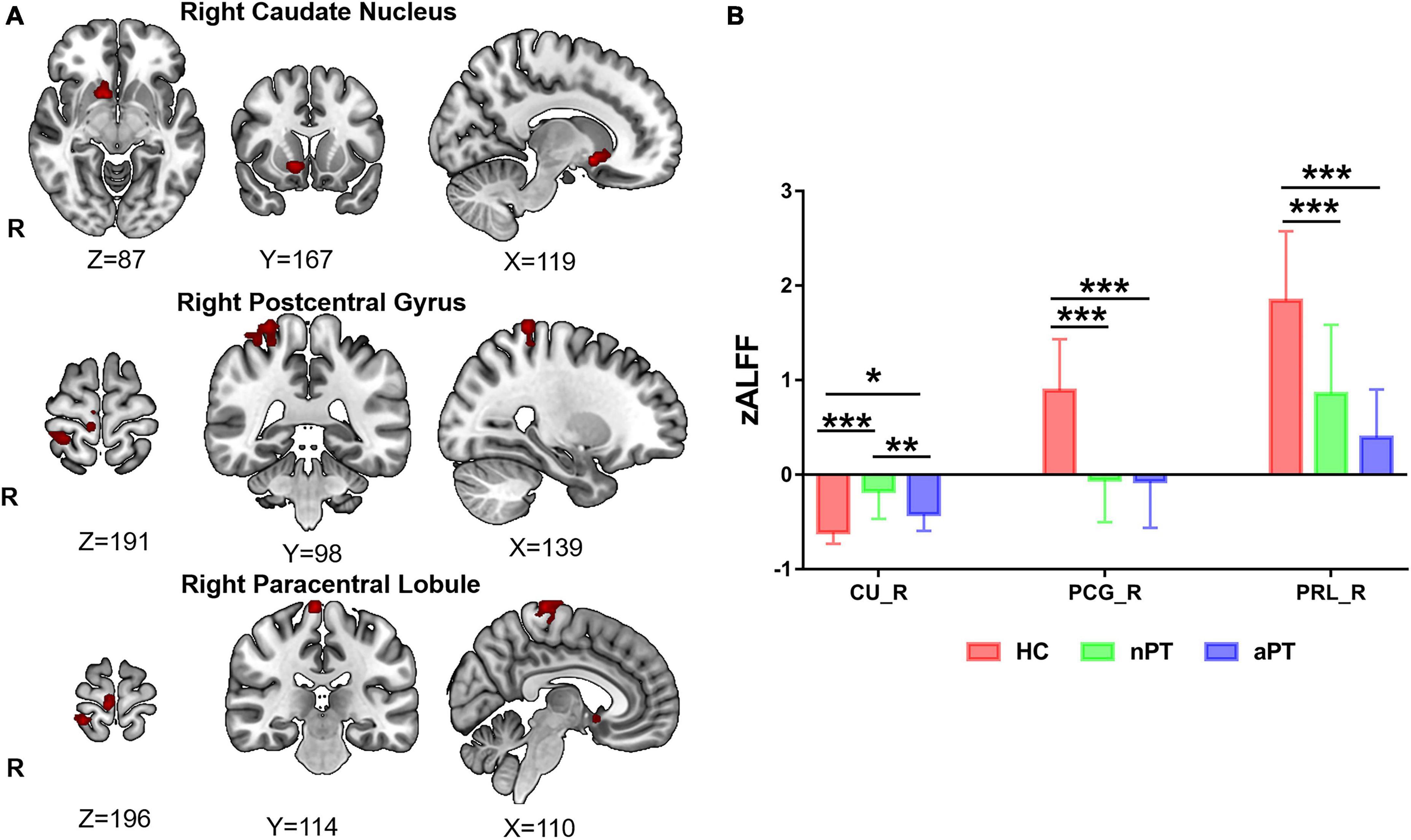 Remodeling of the brain correlates with gait instability in cervical spondylotic myelopathy